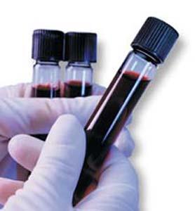 New blood test increases accuracy in prostrate cancer screening