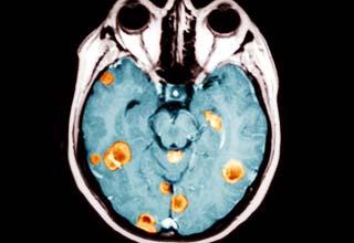 An MRI scan depicting a brain with tumors