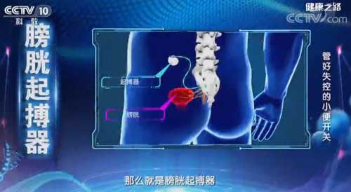 管好失控的小便開關 “3個3”訓練幫您緩解尿失禁