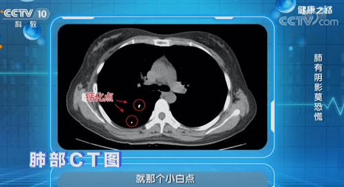 體檢後發現肺部有“陰影” 究竟要不要進一步治療